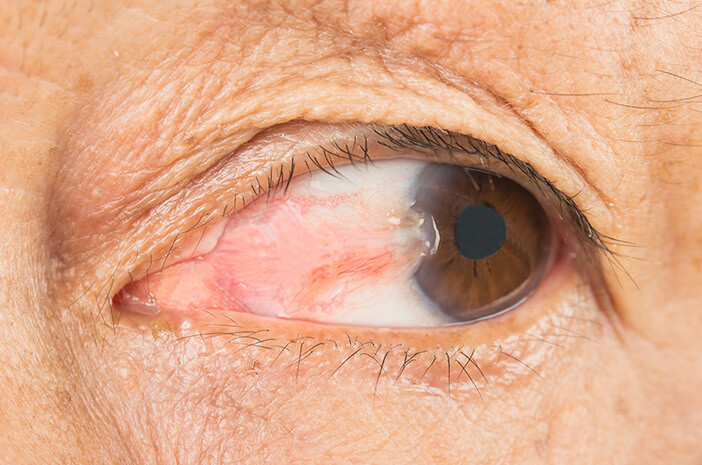 Pterigium
